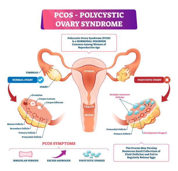 PCOS Treatment